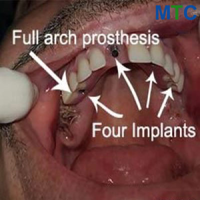 Surgerical Stage of All on 4 dental Implants