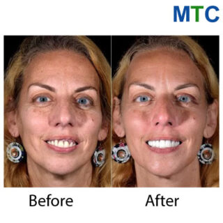 Full mouth restoration in Cancun - Before & after