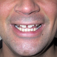 Gaps in Teeth