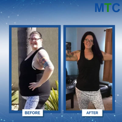 Mini gastric bypass in Tijuana, Mexico - Before & After