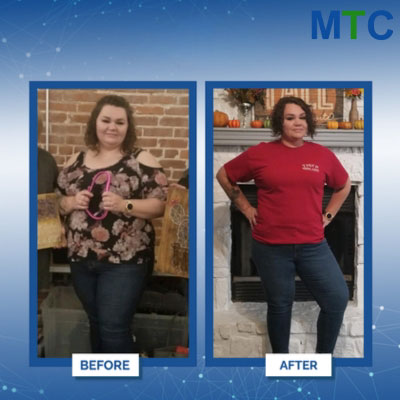 Mini gastric bypass in Tijuana, Mexico - Before & After