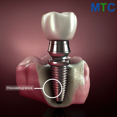 Osseointegration of All on 4 Dental Implants Romania