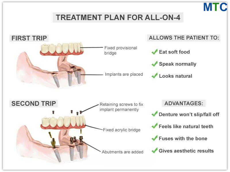 Treatment Plan for all on 4 Dental Implants Romania