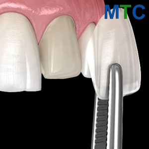 Dental Procedure | Dental Veneers