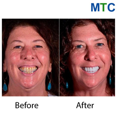 Dental Crowns in Cancun (Before & After)