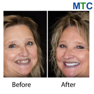 Dental Crowns & veneers in Cancun, Mexico - Before & After