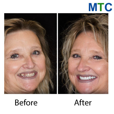 Dental Crowns in Cancun (Before & After)