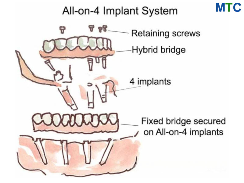 All on 4 implant system