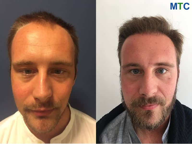 Before After Beard Transplant in Istanbul