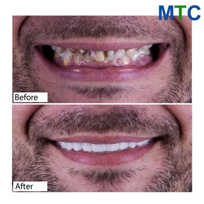 Smile makeover in Cabo - Before & After