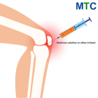 Prolotherapy | Alternative to knee replacement surgery