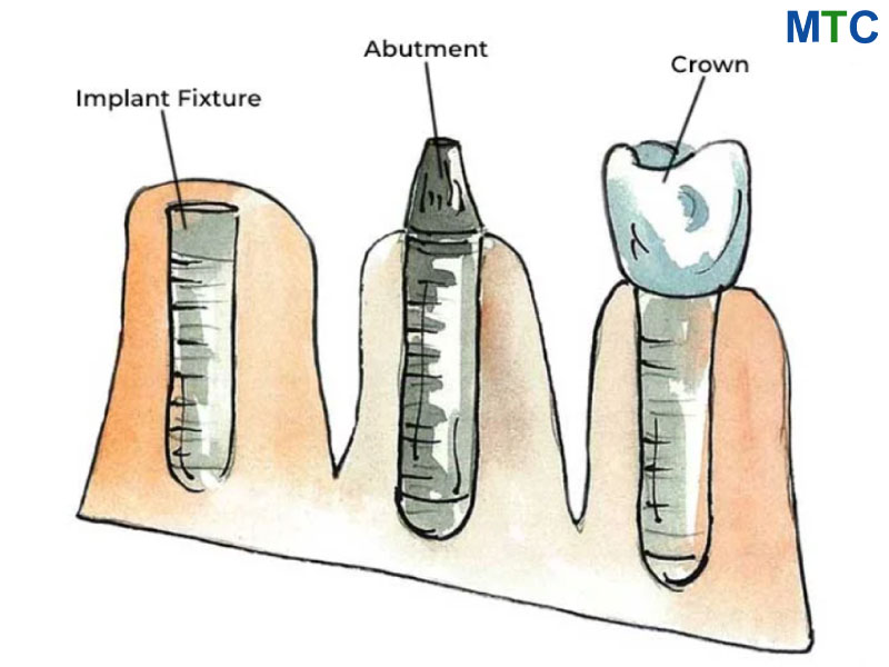 Regular dental implant in Cabo