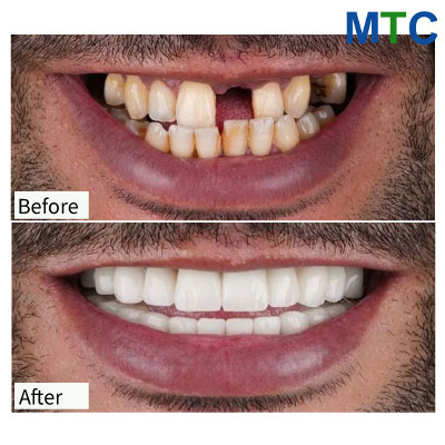 Smile Restoration with Implants & Crowns