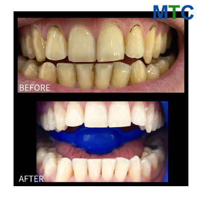Teeth Whitening in Didim, Turkey (Before & After)