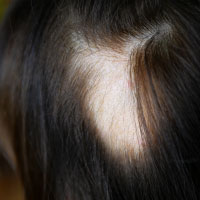 Alopecia Aereata