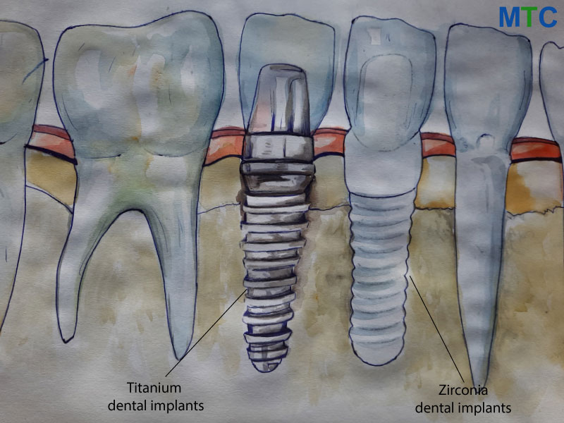 Titanium Vs. Zirconia Dental Implants