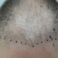 Scalp Area With Thinning Hair
