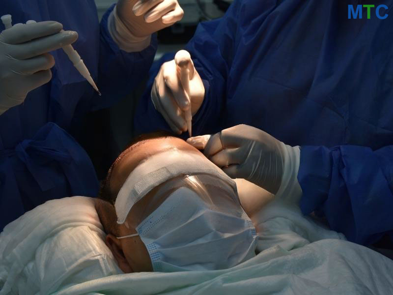 Hair Transplant in Mexico Carried Out Under Local Anesthesia