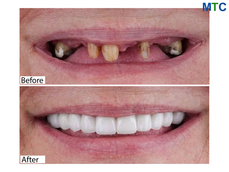 Smile Restoration with Implants, Crown & Bridge