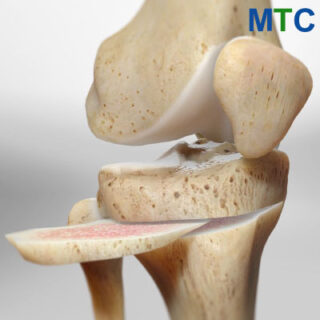 Knee Osteotomy | Alternative to knee replacement surgery