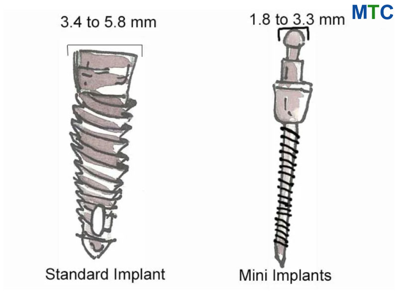 Regular vs Mini dental implant