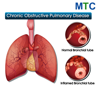 Chronic obstructive pulmonary disease, or COPD