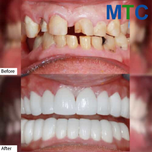 Dental implants in Los Algodones | Before & After